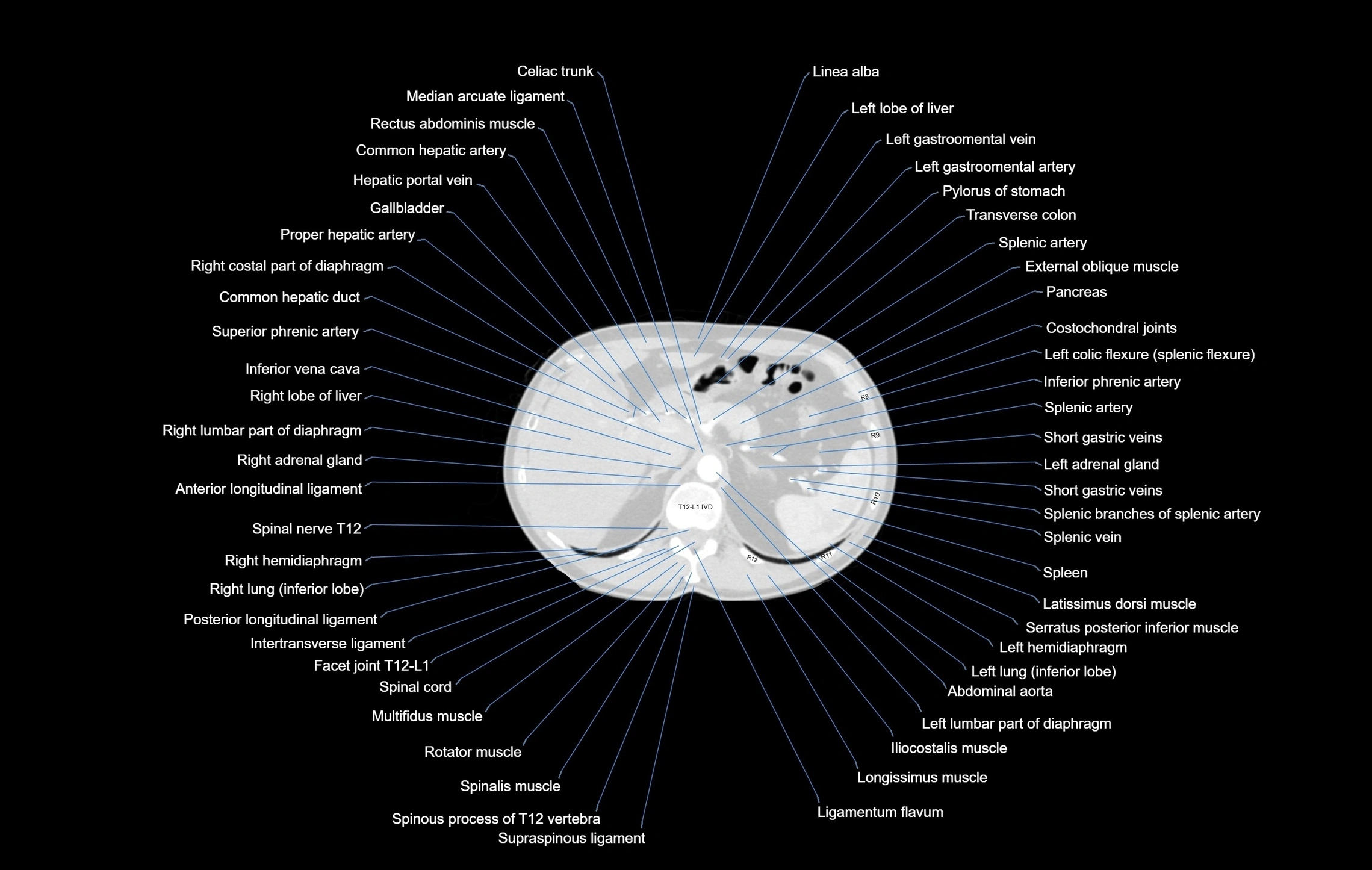 CT chest (thorax) lung window window labelled axial cross sectional anatomy radiology image-00119.webp